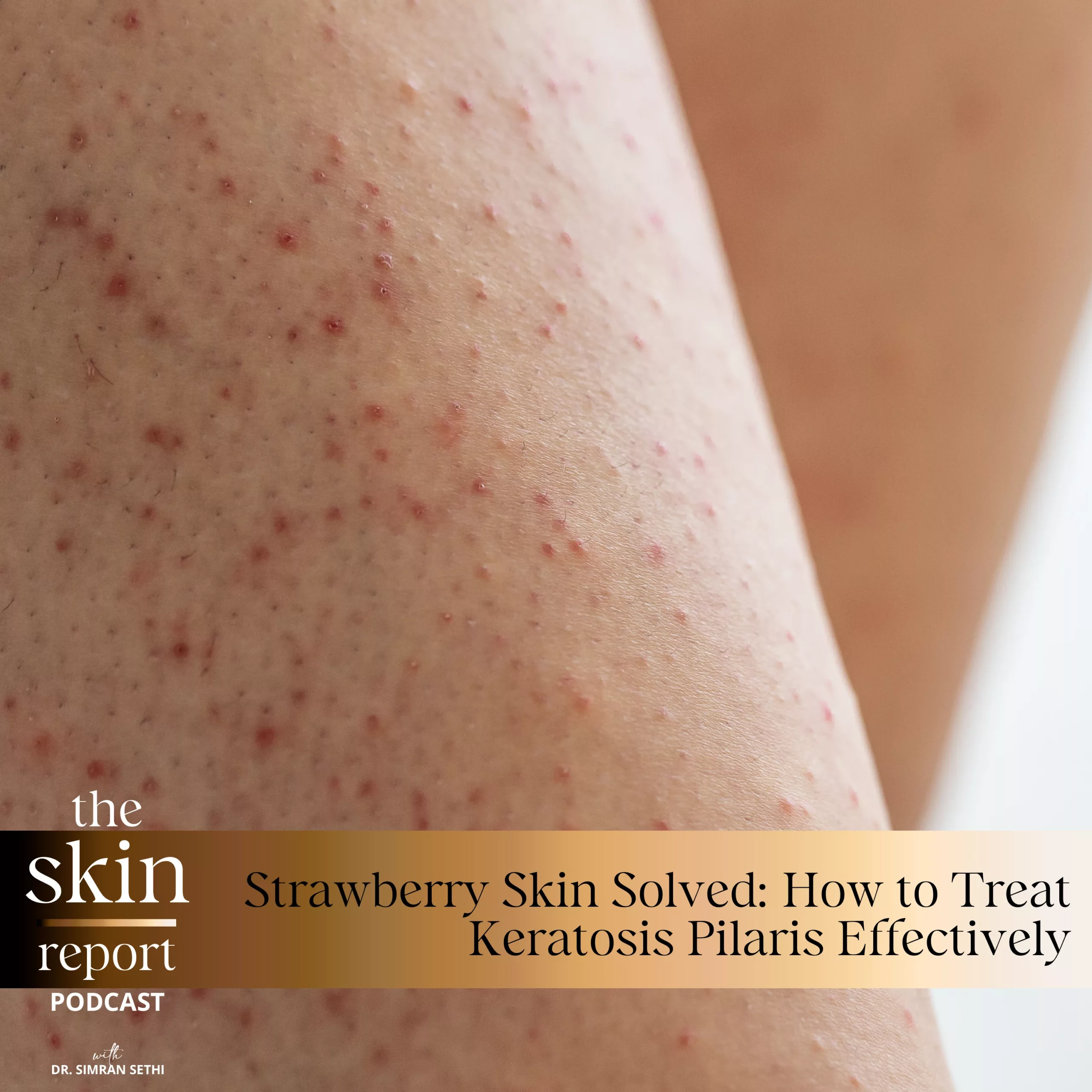Strawberry Skin Solved: How to Treat Keratosis Pilaris Effectively | The SKIN Report Podcast with Dr. Simran Sethi