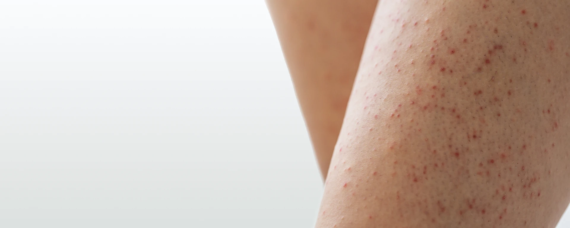 Strawberry Skin Solved: How to Treat Keratosis Pilaris Effectively | The SKIN Report Podcast with Dr. Simran Sethi