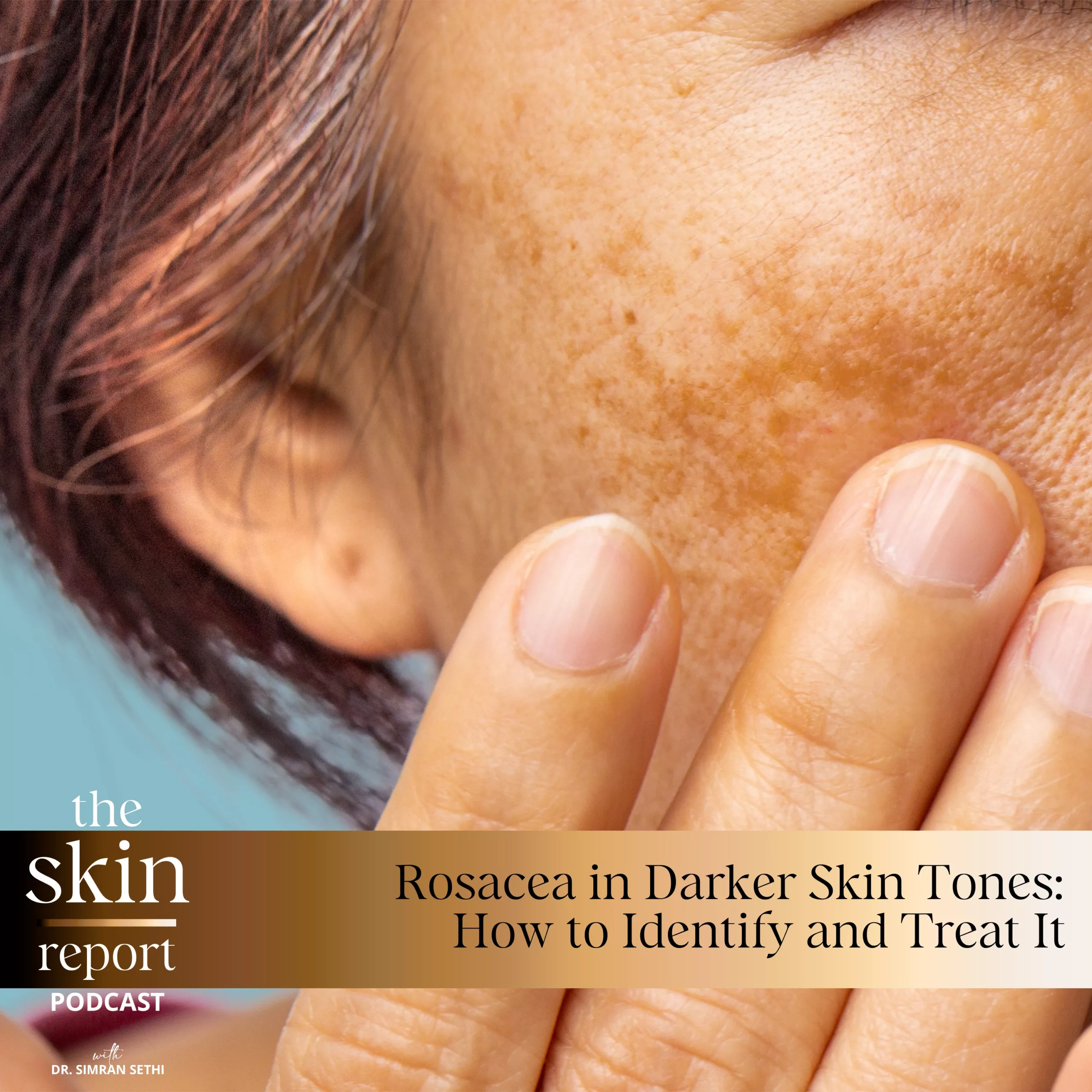 Rosacea in Darker Skin Tones: How to Identify and Treat It | The SKIN Report Podcast with Dr. Simran Sethi