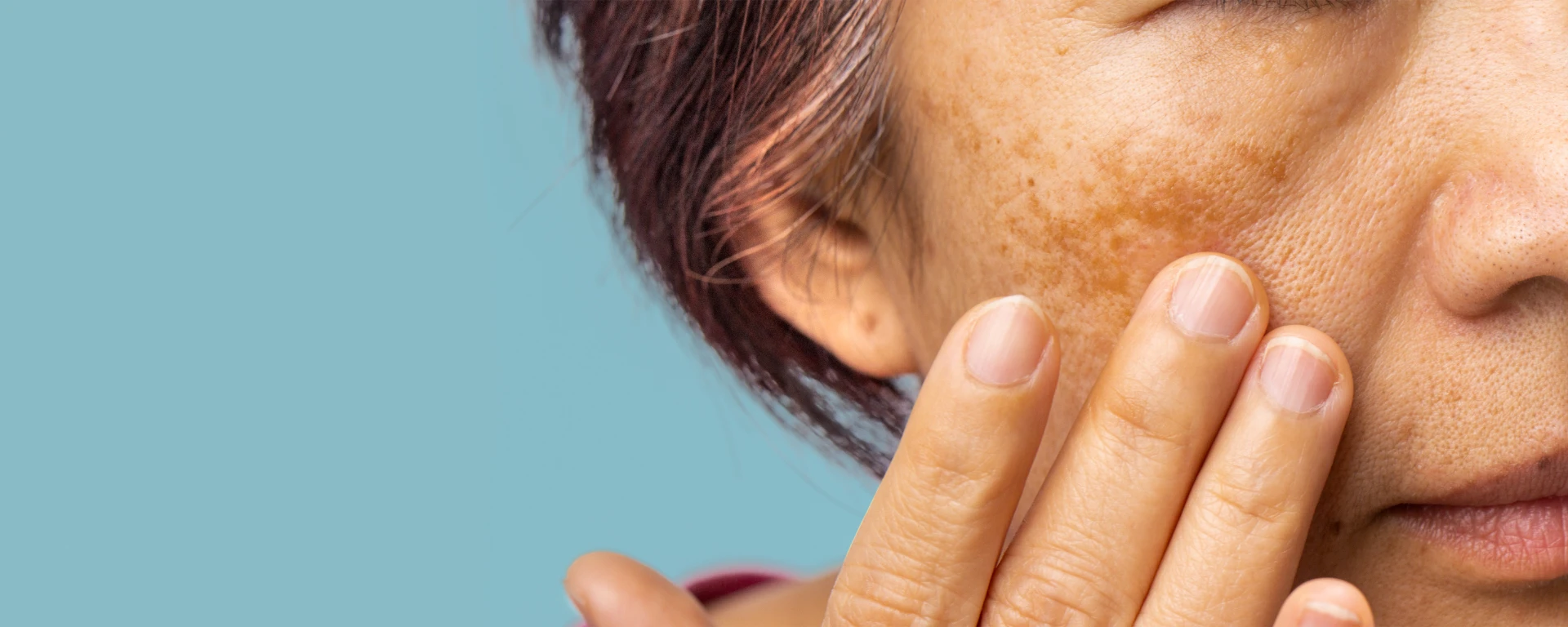 Rosacea in Darker Skin Tones: How to Identify and Treat It | The SKIN Report Podcast with Dr. Simran Sethi